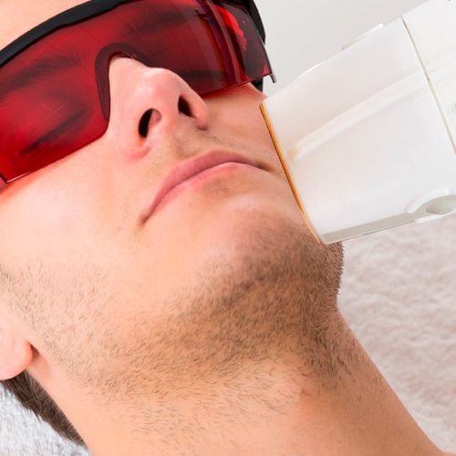 Depilación Láser Cara Masculina x 8 sesiones