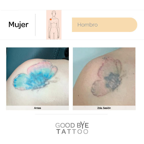 Eliminacion-de-Tatuaje-1