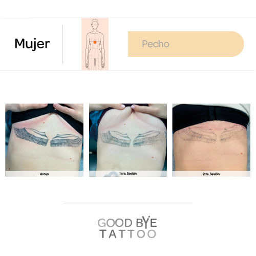 Eliminacion-de-Tatuaje-2