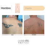 Eliminacion-de-Tatuaje-3