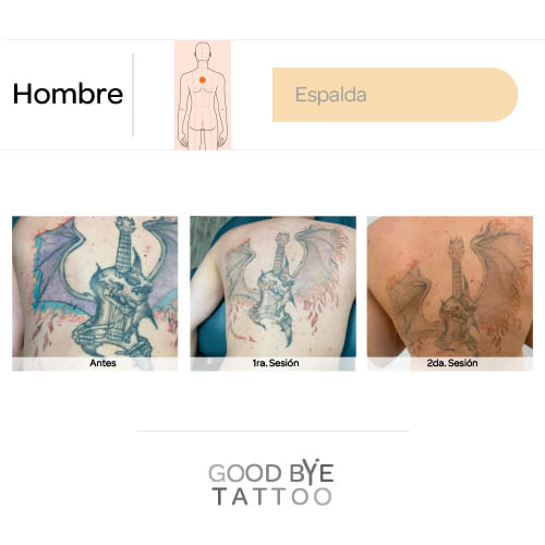 Eliminacion-de-Tatuaje-4