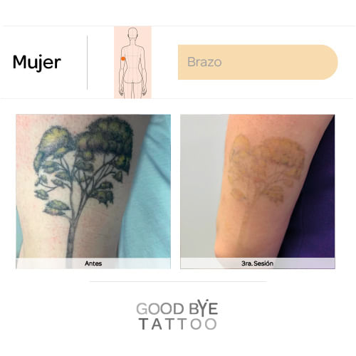 Eliminacion-de-Tatuaje-5