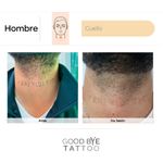 Eliminacion-de-Tatuaje-6