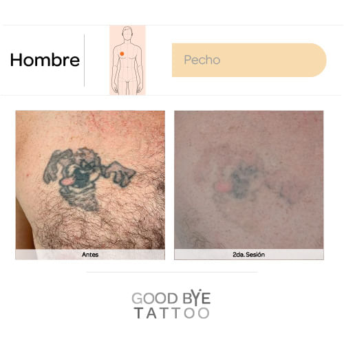 Eliminacion-de-Tatuaje-7
