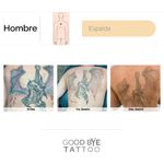 Eliminacion-de-Tatuaje-4